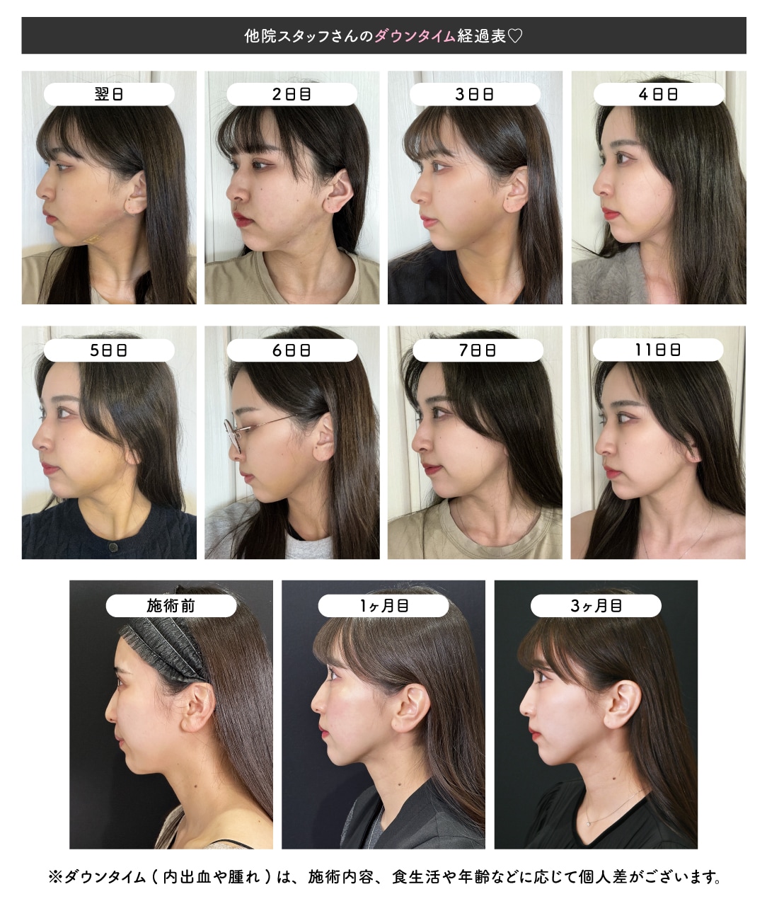 顔脂肪吸引の腫れピークはいつ？術後2〜3日の真相と早期回復の全技術