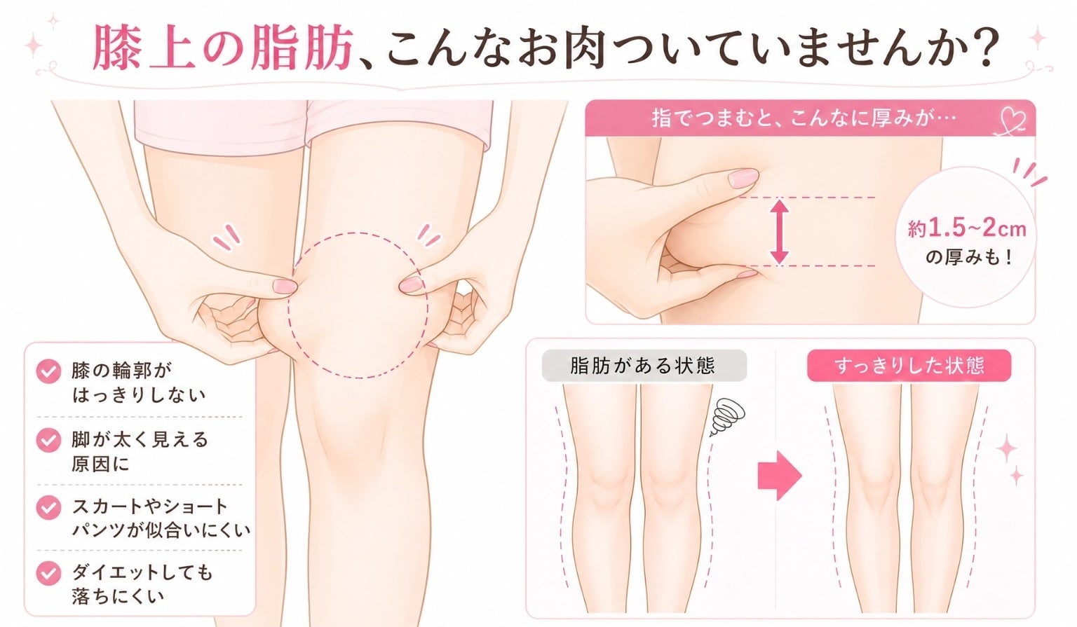 膝の肉の落とし方完全解剖！ぽっこり贅肉の原因と即効美脚ストレッチ