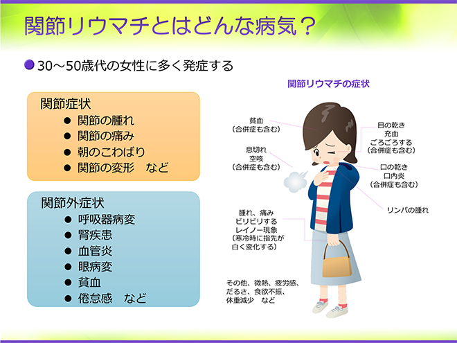 リウマチになりやすい性格の女性とは？完璧主義の真相と初期サイン