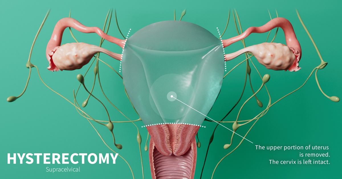 Sex After Hysterectomy with Cervix Removal