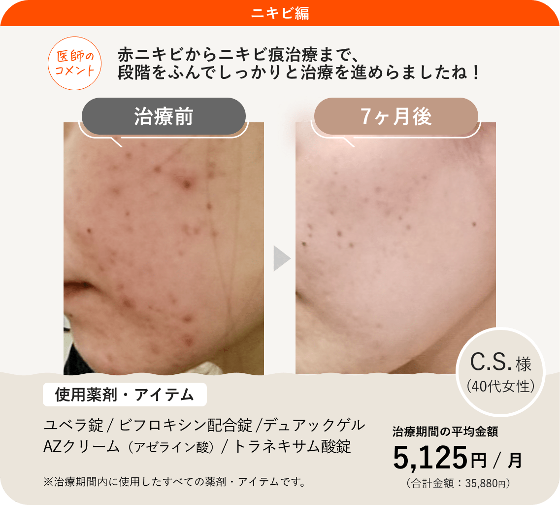 アゼライン酸の効果とは？ニキビや赤み・毛穴への変化と真相を徹底解明