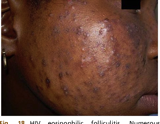 Face Sign of Hiv