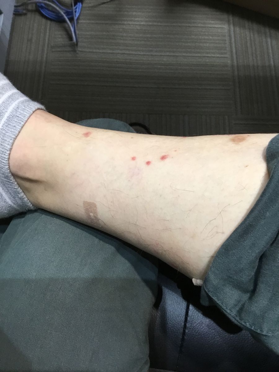 ノミに噛まれた跡の正体と治し方｜ダニとの違い・消えない黒ずみ対策