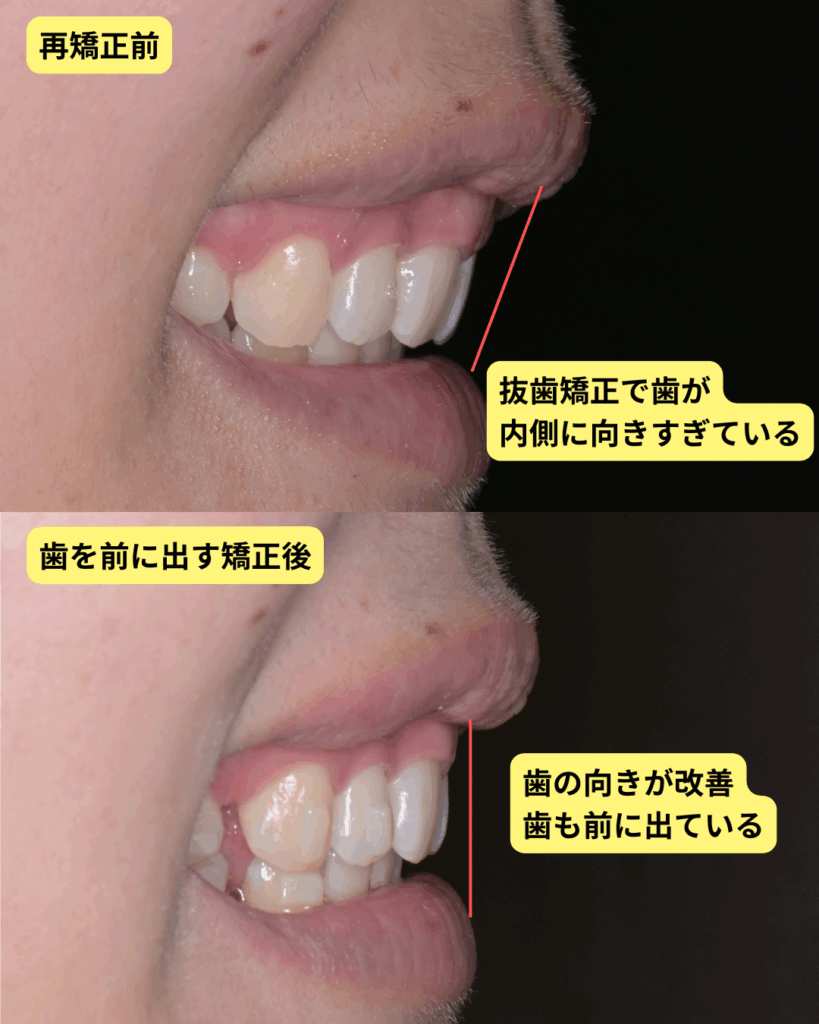 抜歯矯正で口元が引っ込みすぎ？老け顔や後悔を防ぐ修正法と診断基準
