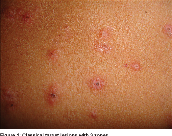 Steven Johnson Syndrome Mild Cases