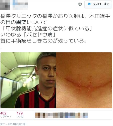 本田圭佑のバセドウ病疑惑と手術痕の真相｜2026年現在の健康状態