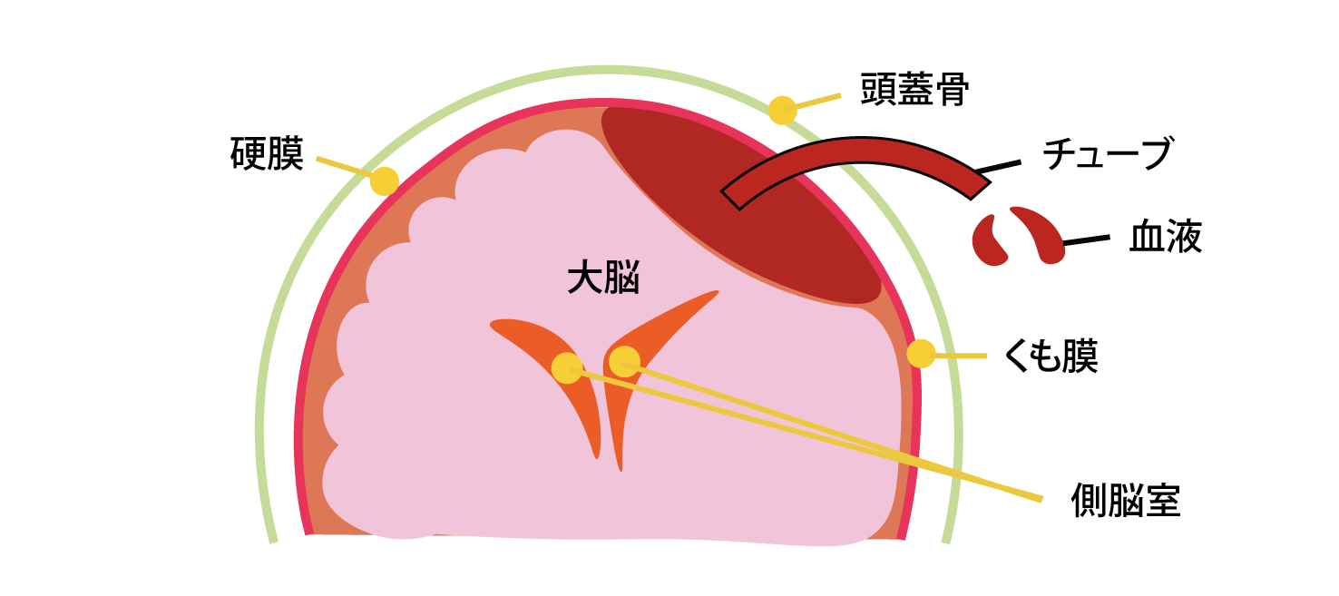 頭部打撲後に潜む硬膜下血腫の真実｜初期症状と急性・慢性の違い