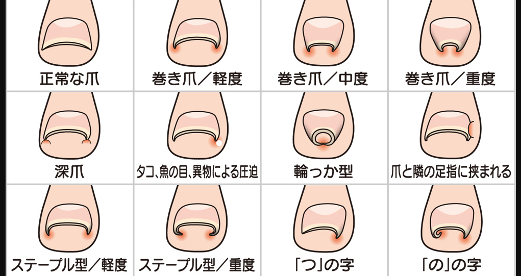 【画像あり】 爪 に 現れる 病気 の サイン 私服＆私生活最新ショット #764