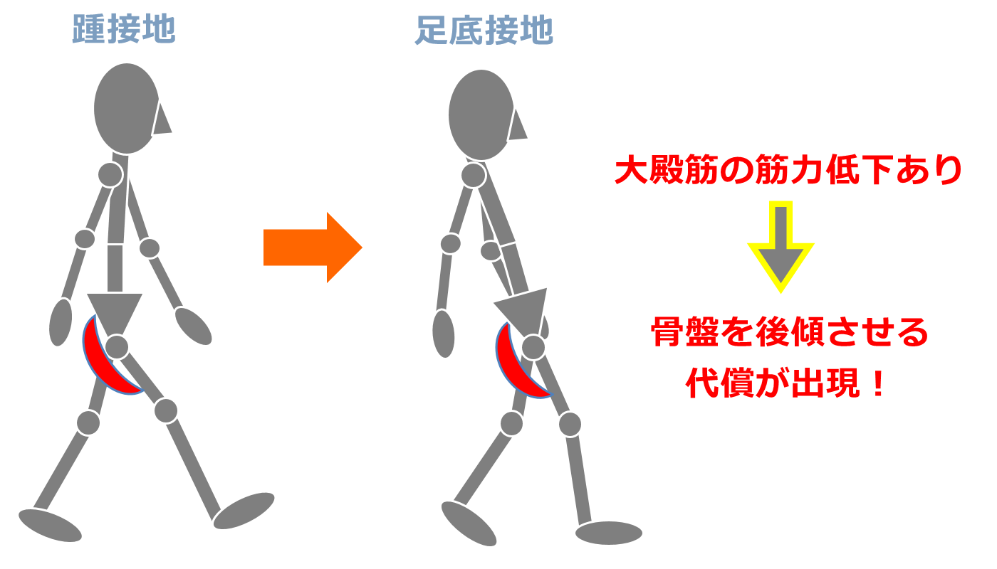 大臀筋歩行のなぜを解明！中臀筋歩行との違いや体幹後屈の理由と最新改善法