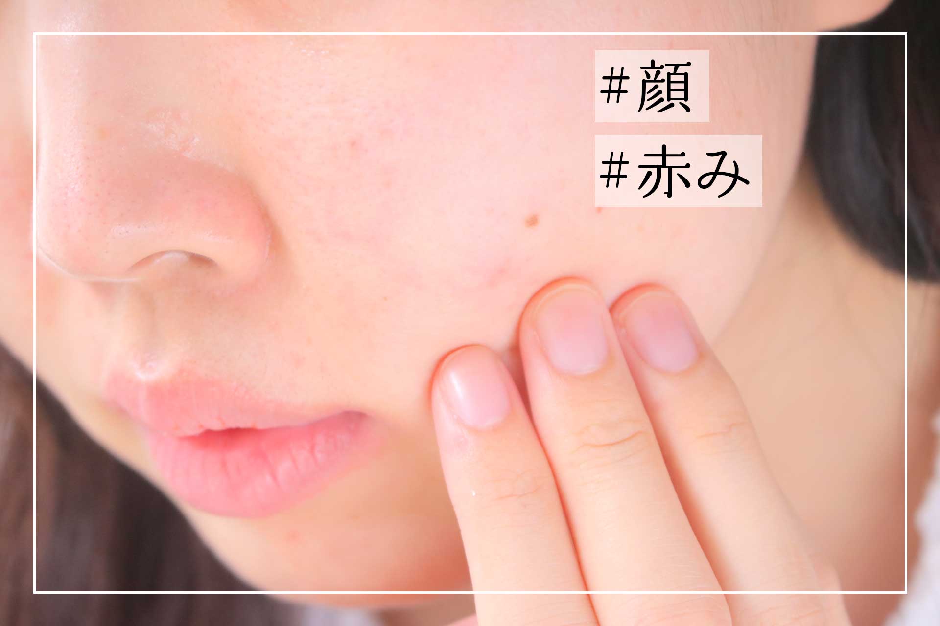 熱はないのに顔が赤い原因とは？赤ら顔の治し方と隠れた病気の真相