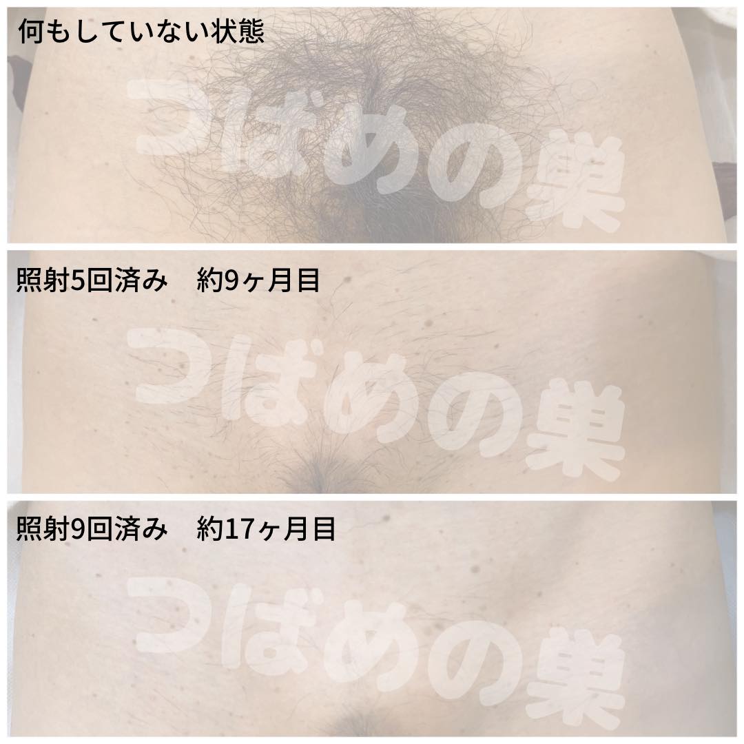 【2026最新】女性Vio脱毛の写真と経過！何回でツルツルになる？