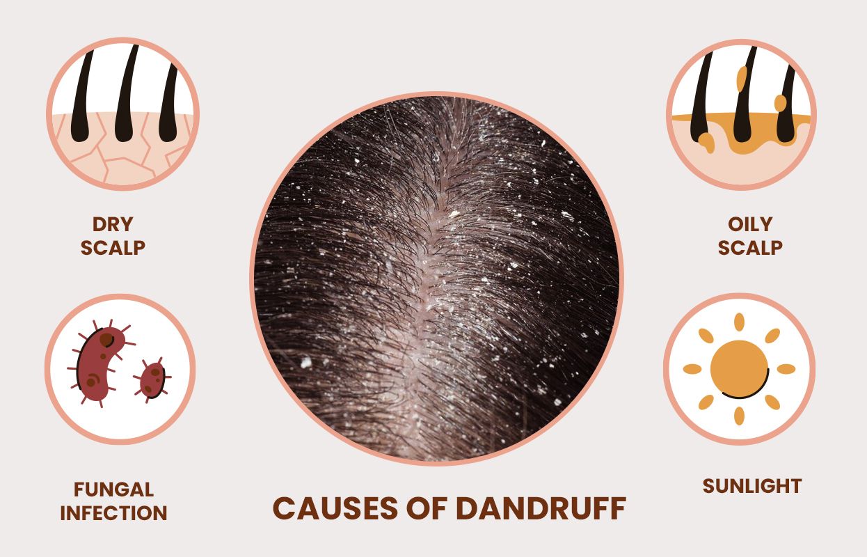 What Is the Cause of Dandruff and Dry Scalp