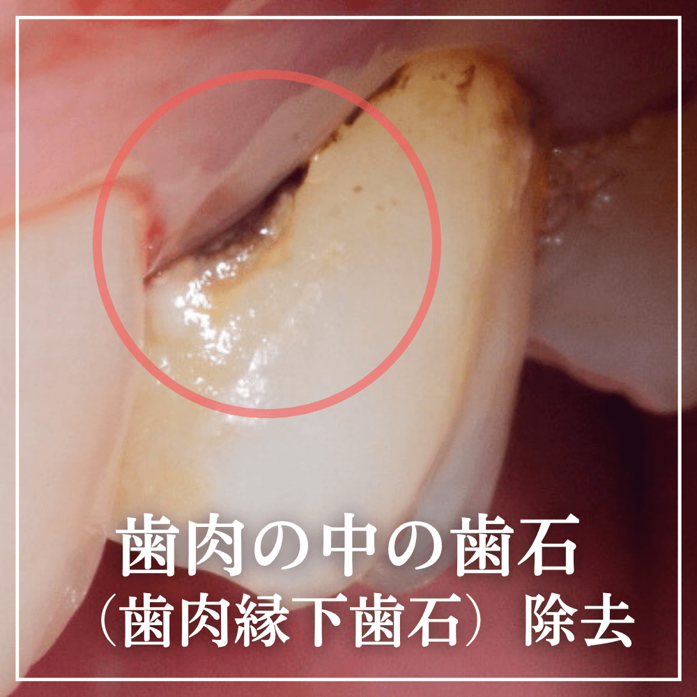 歯茎の奥に潜む「縁下歯石」の恐怖！放置で抜歯？痛みや費用相場を徹底解説