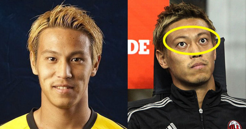 本田圭佑とバセドウ病の真実｜首の腫れ痕と壮絶な闘病の舞台裏