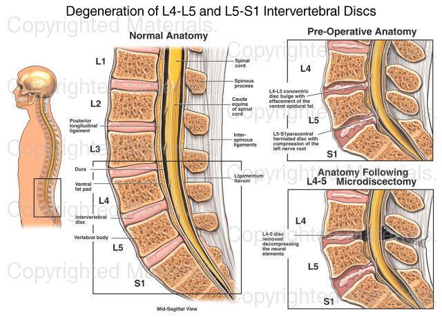 Disk Degeneration L4 L5