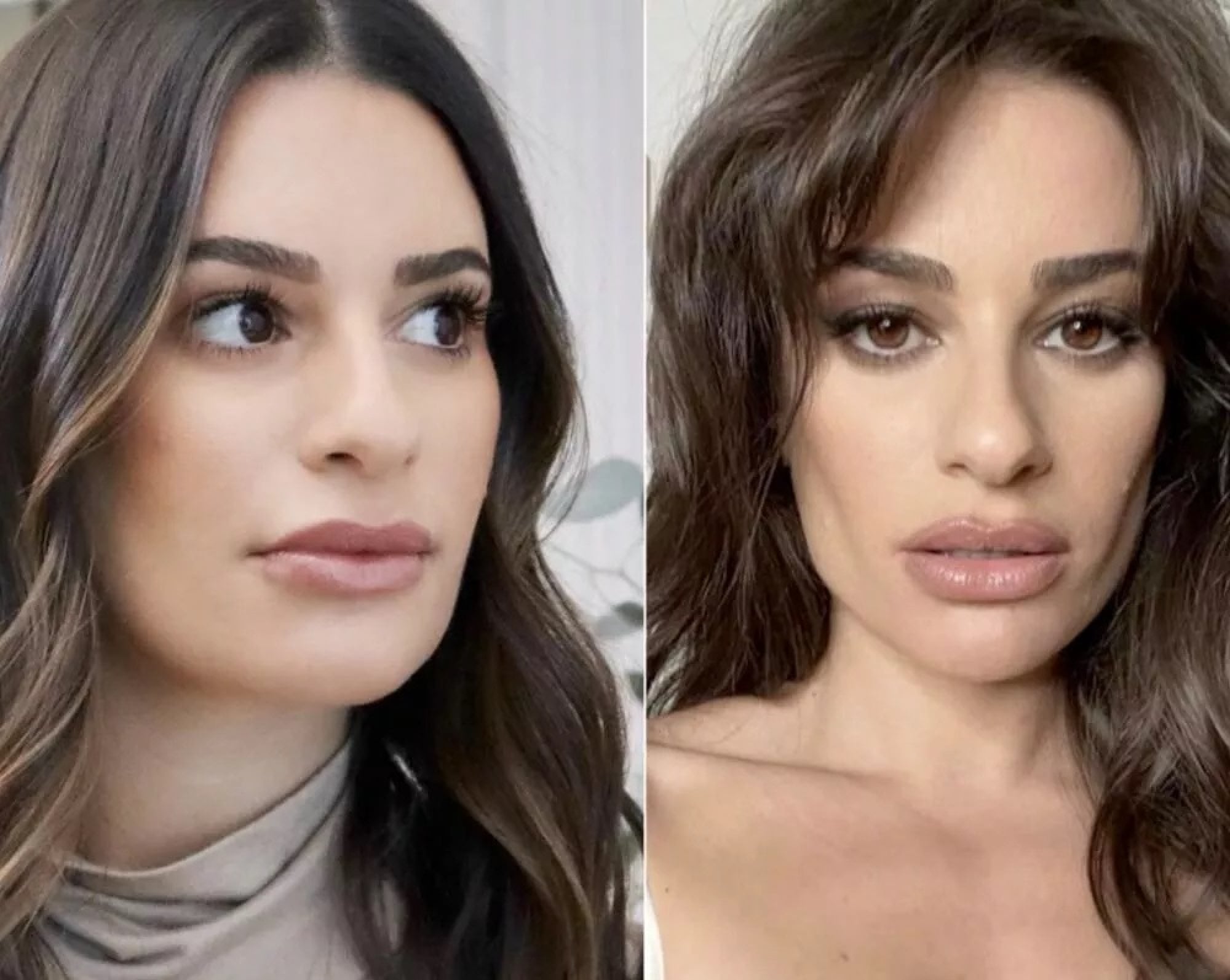 Buccal Fat Removal Before and After Celebrity