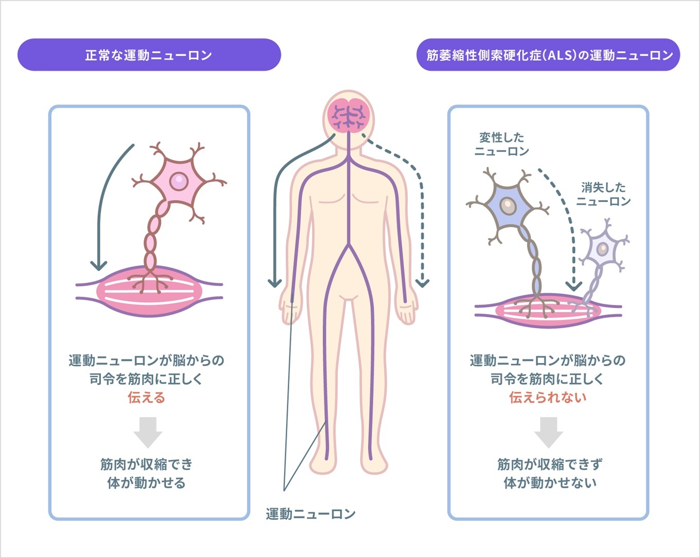 筋萎縮性側索硬化症の原因とは？最新研究と発症メカニズムの真相