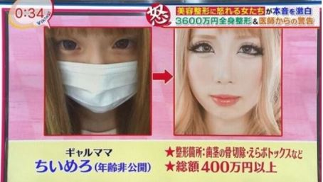 総額数千万円超？ちいめろが語る「整形と美の終着点」——2026年、彼女が変わり続ける本当の理由