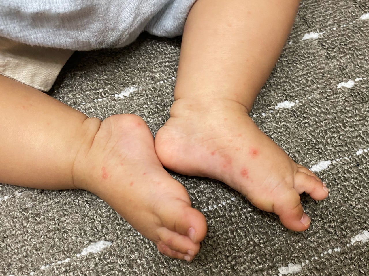手足口病で足だけに発疹？手や口に出ない理由と見分け方を徹底解説