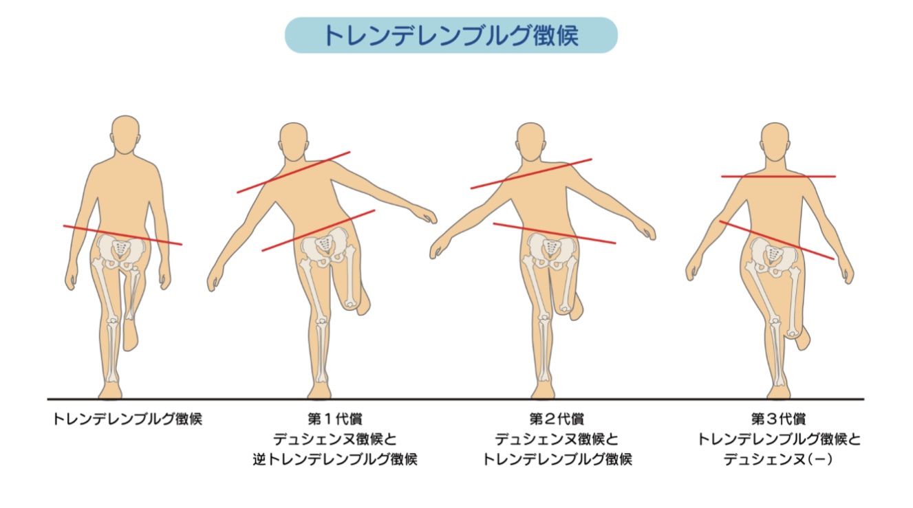 トレンデレンブルグ徴候の原因とは？デュシェンヌ徴候との違いとリハビリ法