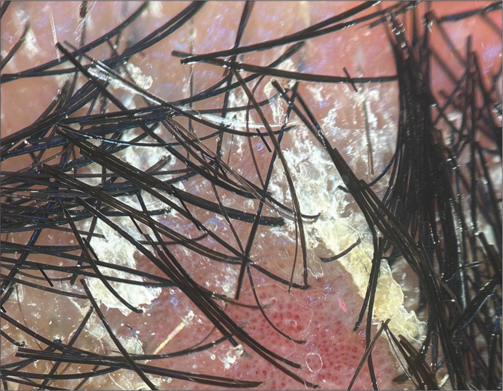 White Scales on Scalp