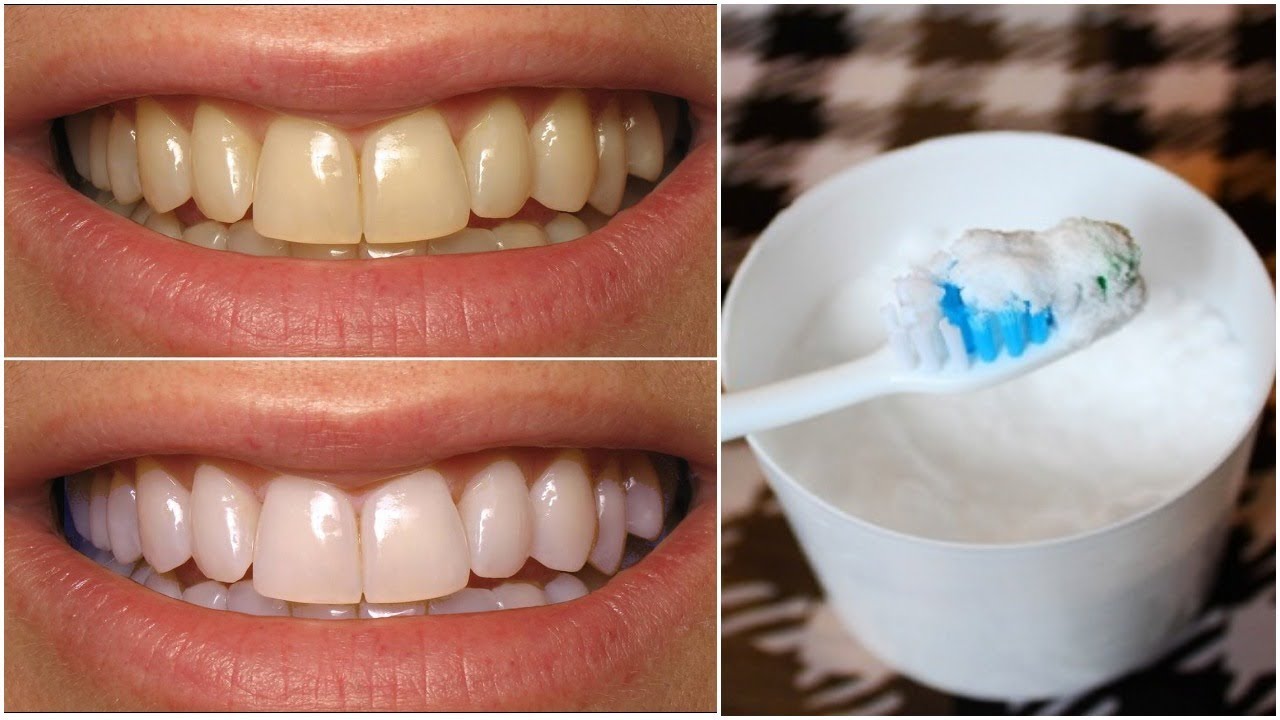 Do Baking Soda Make Your Teeth White