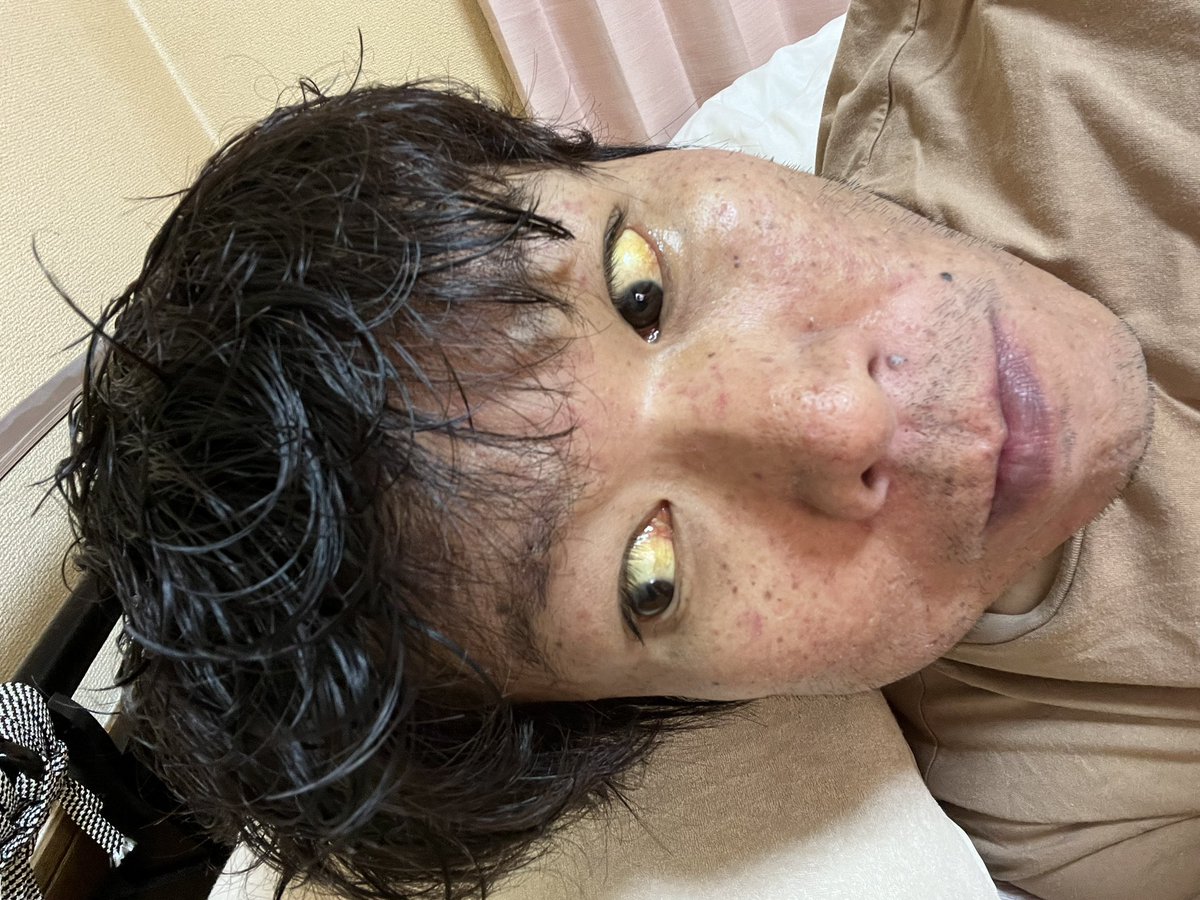 金バエの肌変色と黄疸の真相とは？末期肝硬変と闘う配信者の現状