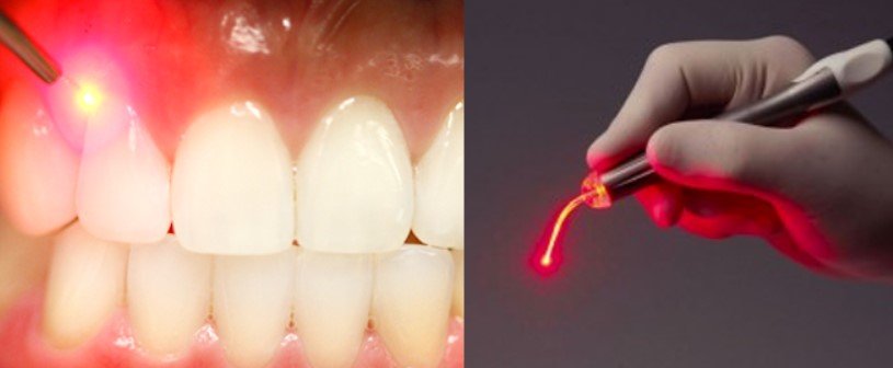 Does Red Light Therapy Work for Gum Recession