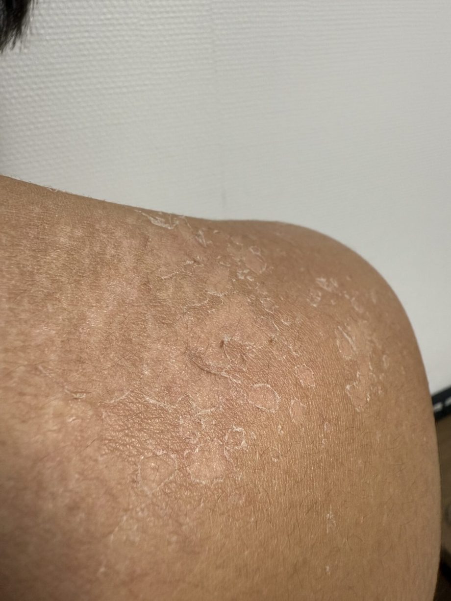 日焼けの皮むけは無理に剥がすな！痕を残さない最新皮膚ケア術