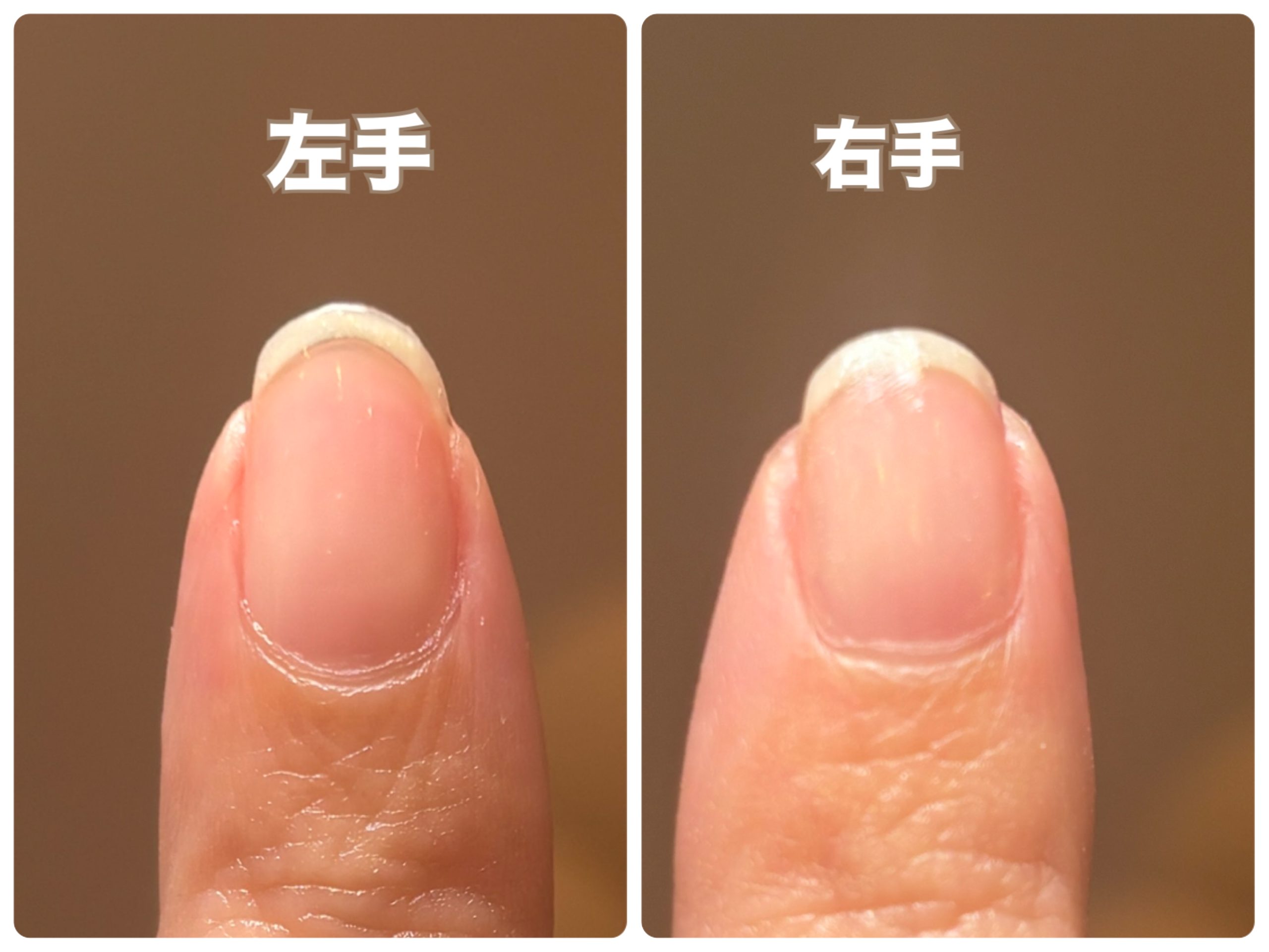 爪のピンクの部分を伸ばす方法！ハイポニキウム育成と深爪改善の真実