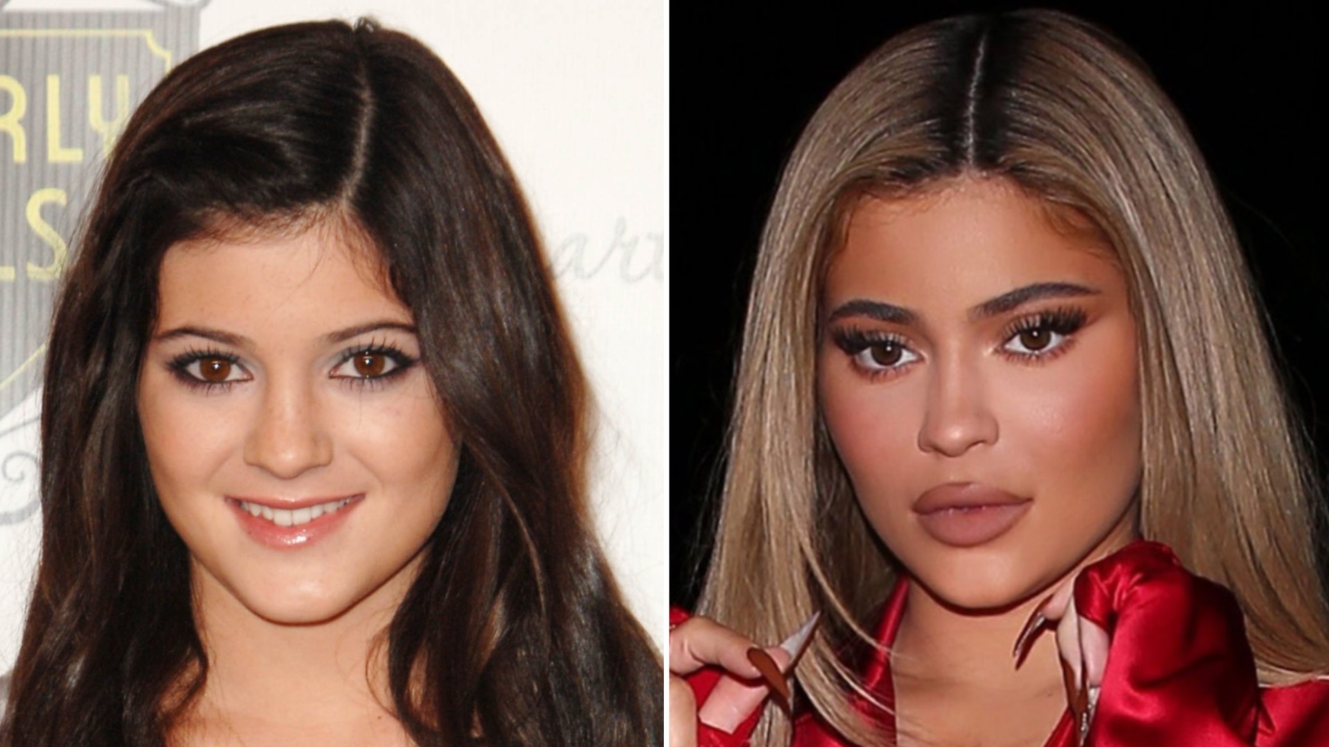 Kylie Jenner Before After Plastic Surgery