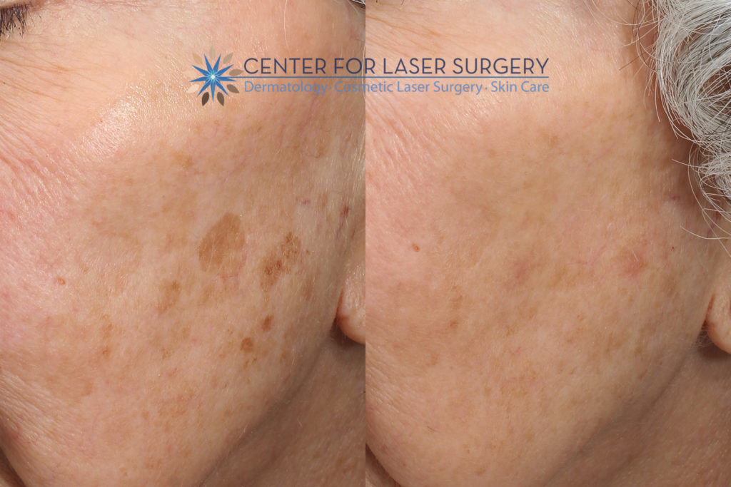 How Do You Remove Brown Spots from Face