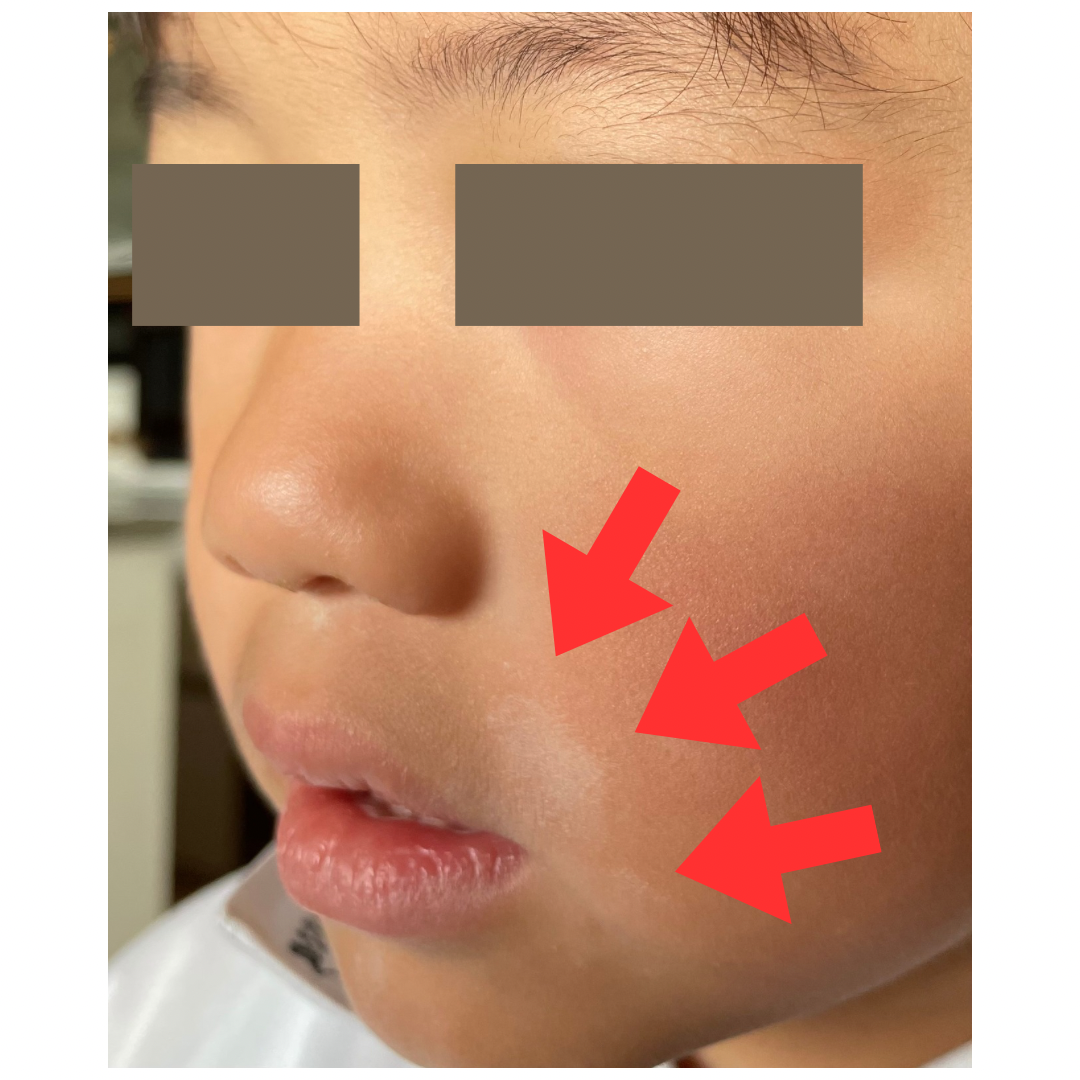 顔の白い斑点は何？白斑とはたけの見分け方と正しい対処法
