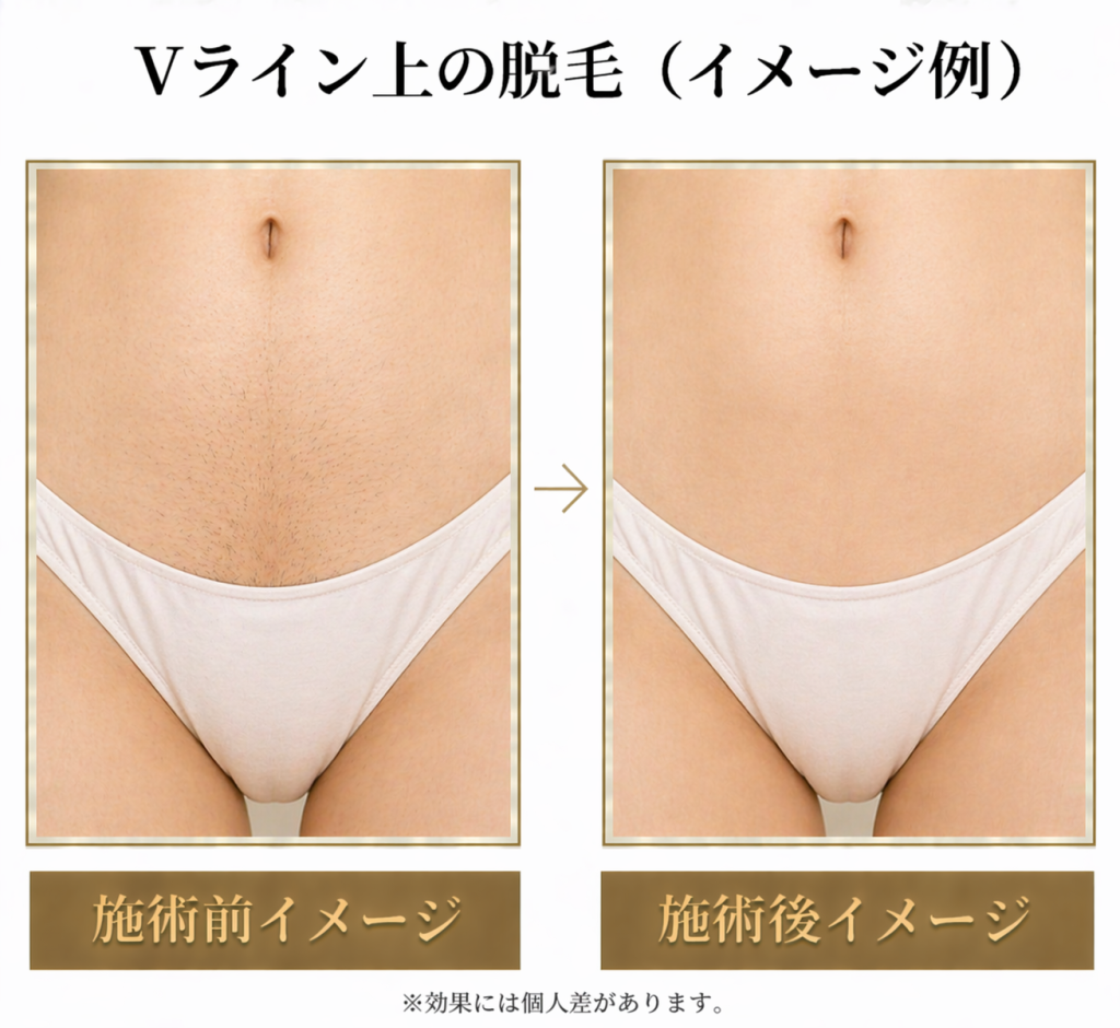 Vライン脱毛写真で見る効果と回数！失敗しない人気デザイン徹底検証