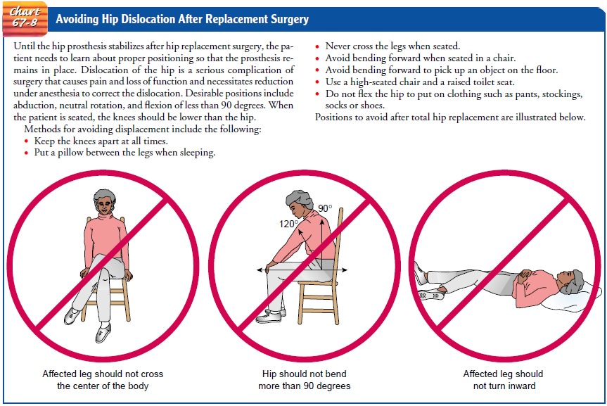 Positions to Avoid After Anterior Hip Replacement