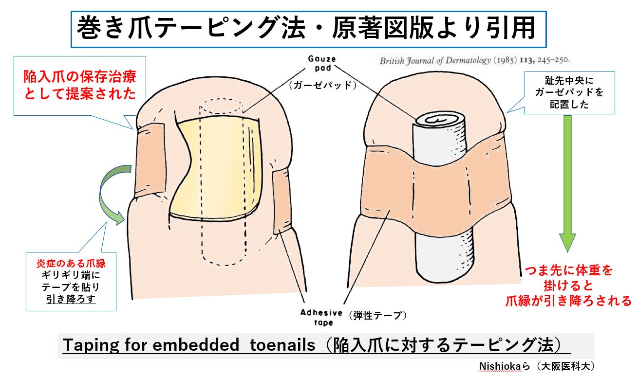 巻き爪テーピングで痛みを即解消！正しい巻き方とNg例を徹底解説