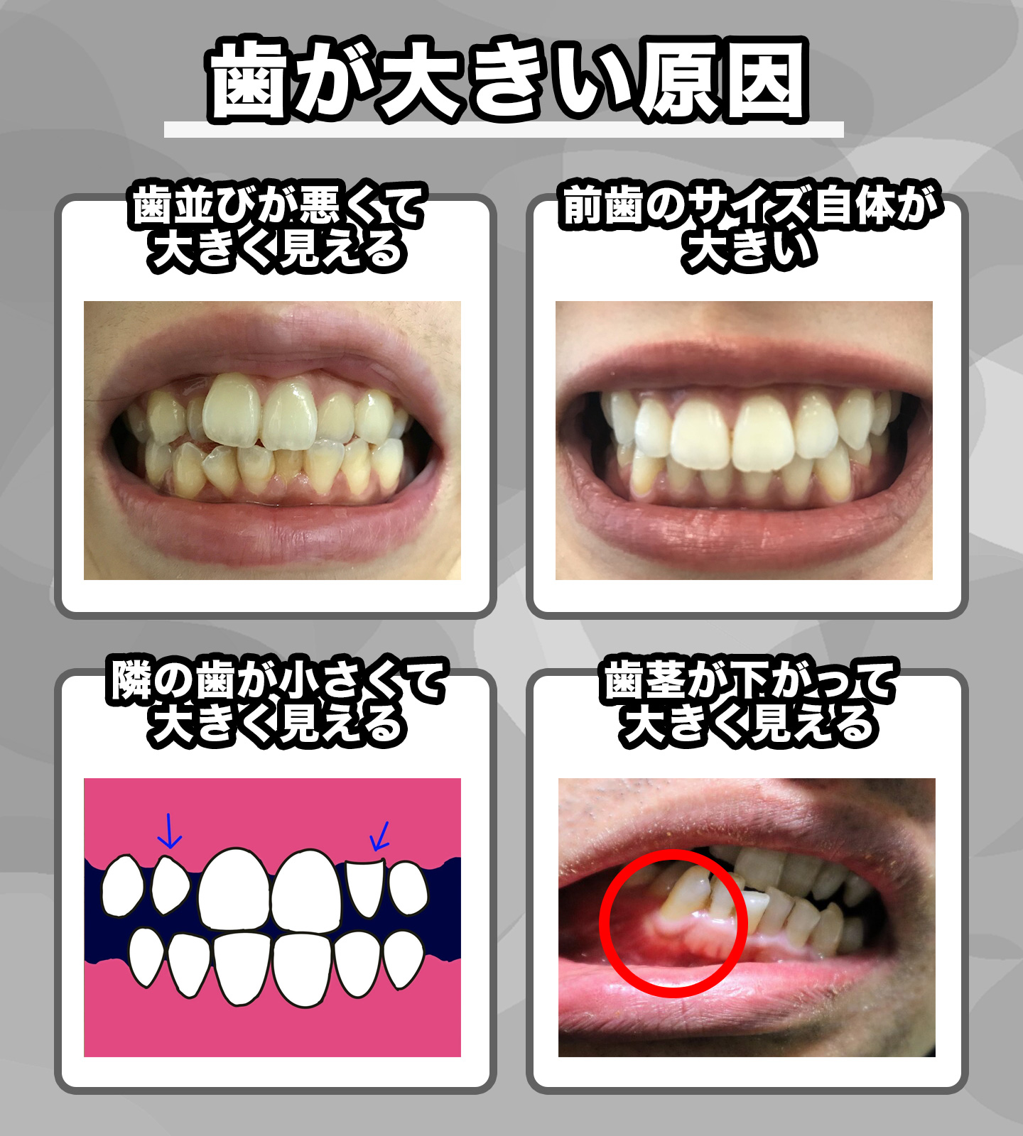 大きい前歯を削る費用と後悔リスク｜保険適用や最新治療の相場を徹底検証