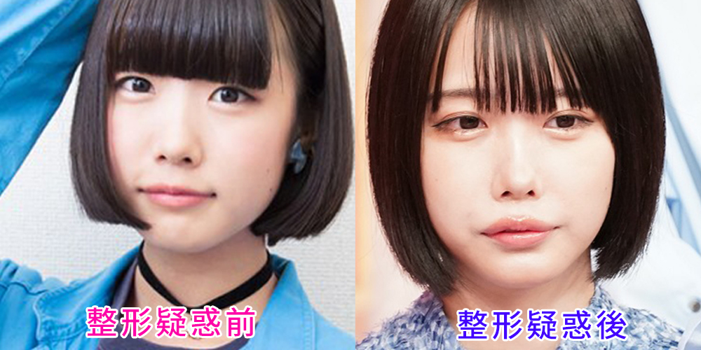 あのちゃんの「整形前」噂を検証！地下アイドル時代から現在に至るビジュアル変遷と進化の真実