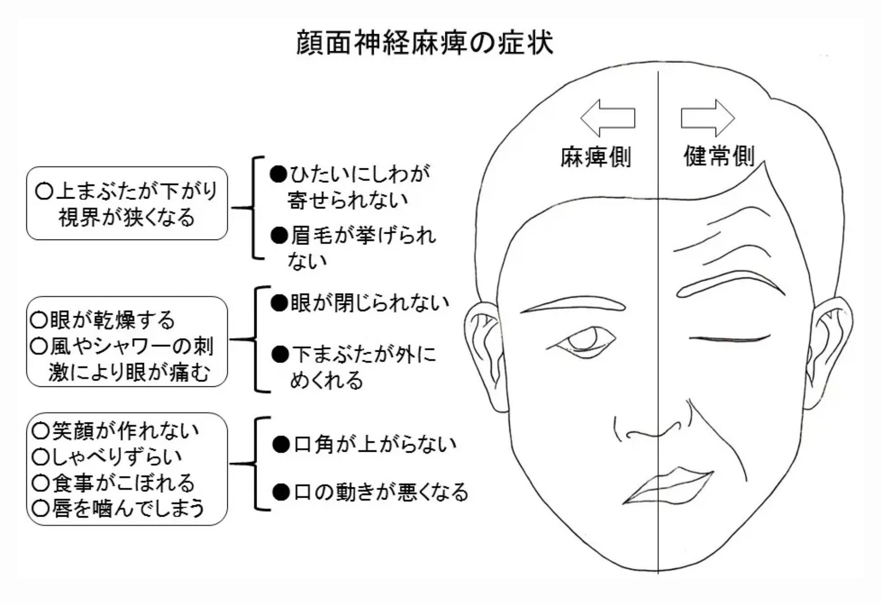 ラムゼイハント症候群の初期症状と完治期間｜ベル麻痺との違いと最新治療法