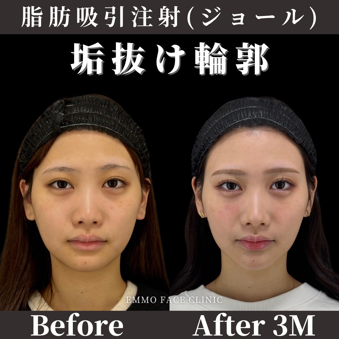 ほっぺの肉を落とす方法の真相！脂肪じゃない原因と即効小顔の真実