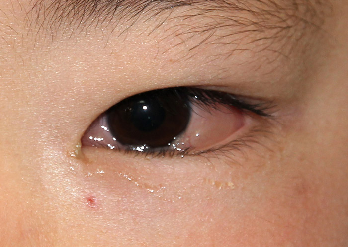 【2026年最新】泣いた後の目の腫れを短時間で消す！皮膚科医が明かす科学的メカニズムと即効レスキュー法