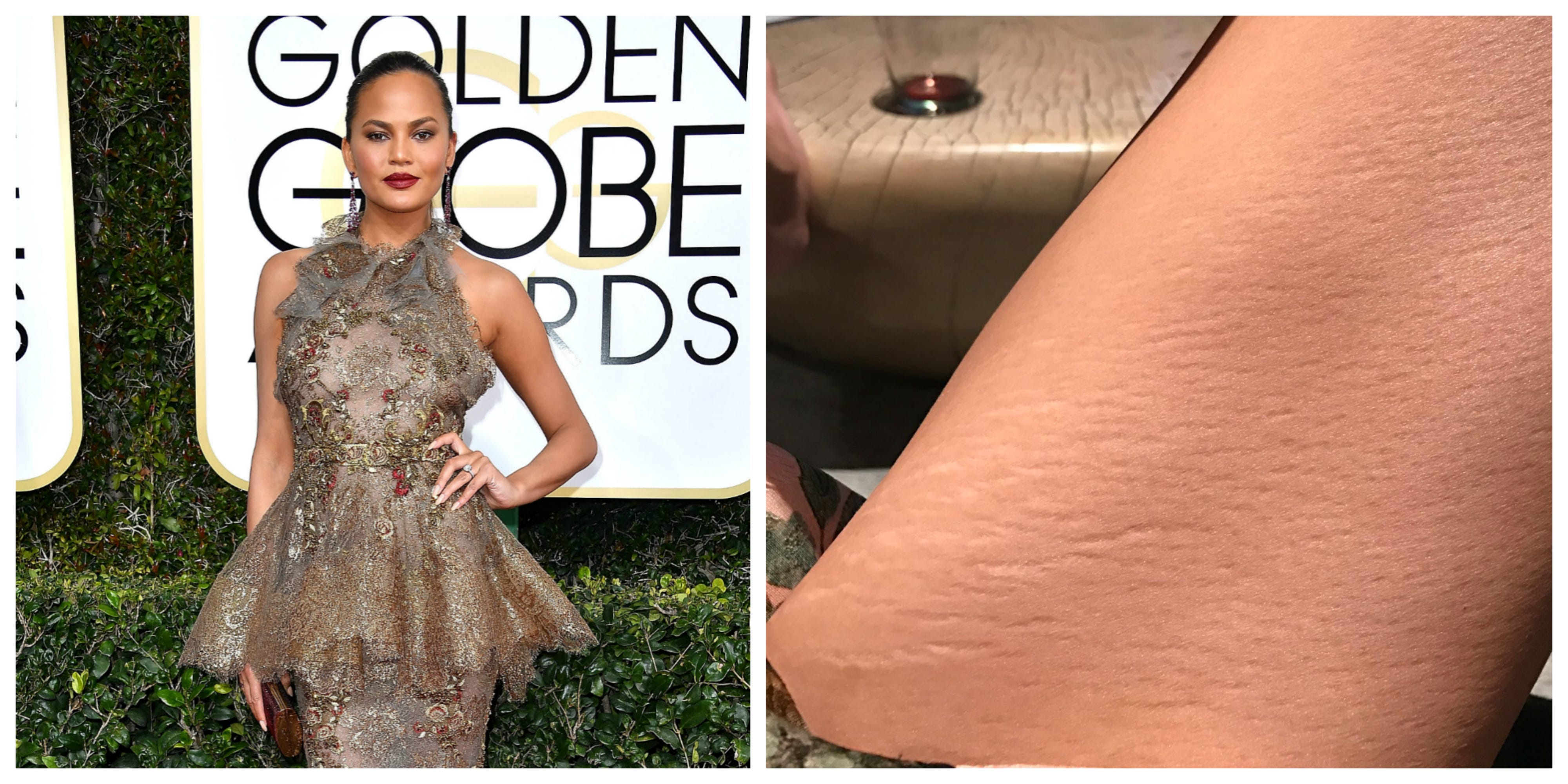 Do Any Celebrities Have Stretch Marks