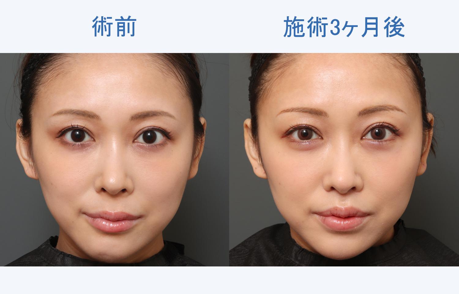 人中を短くする方法を徹底網羅！即効メイクから整形の失敗リスクまで検証