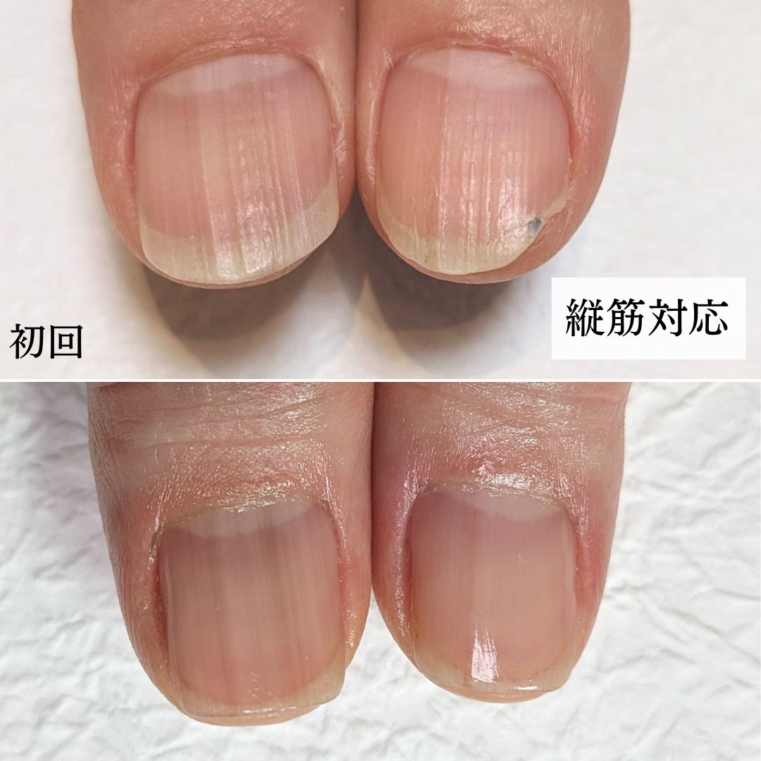 爪の縦線は危険な病気の兆候か？黒い筋の正体と皮膚科受診の目安