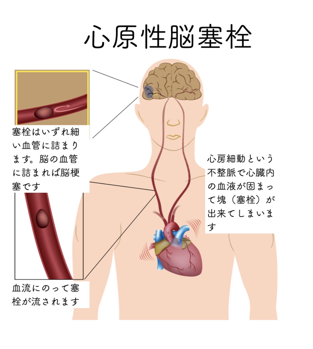 心原性脳塞栓症はなぜ突然襲うのか？心房細動の盲点と命を救う最新治療