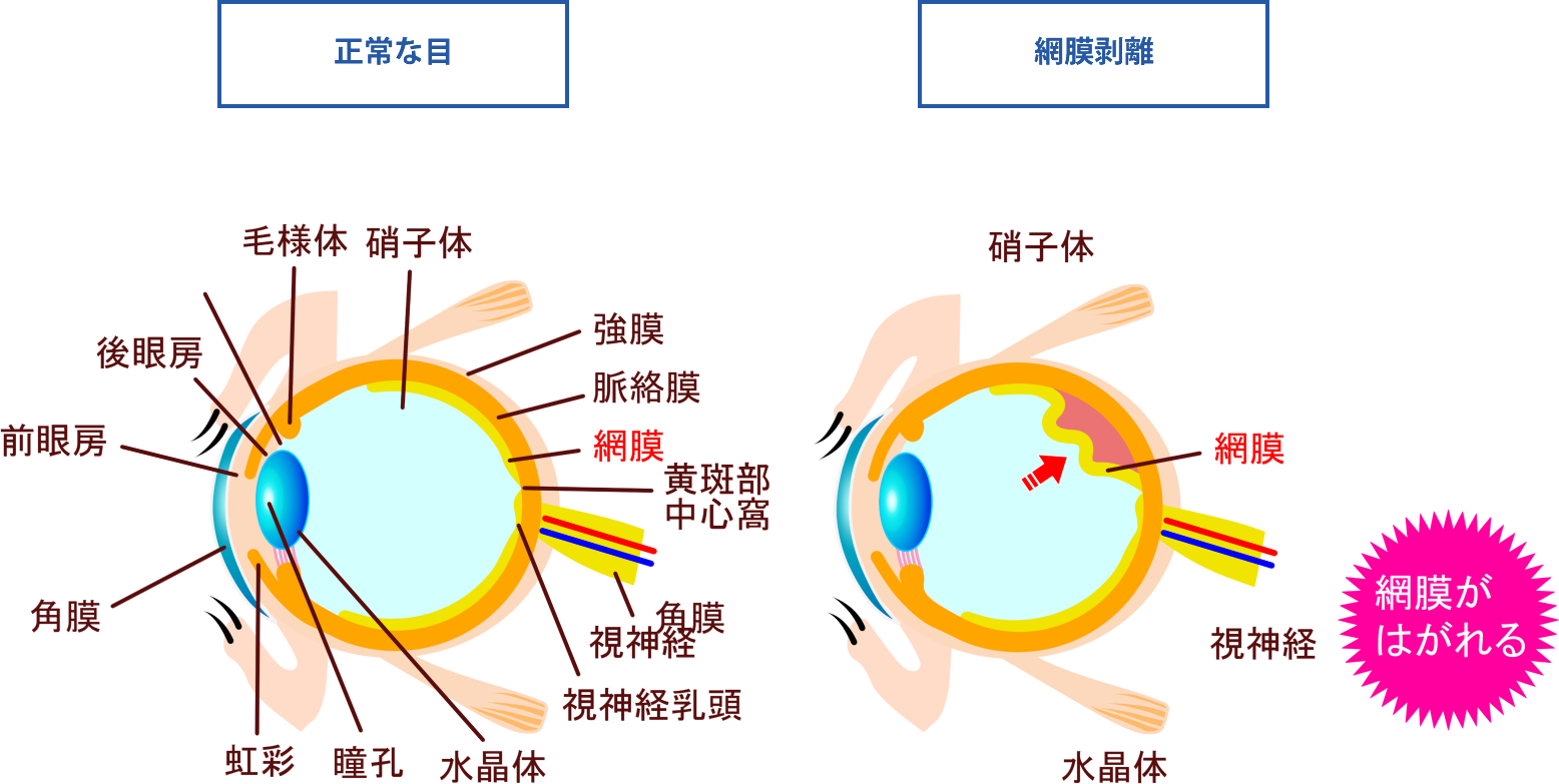 【2026年最新】網膜剥離とは？前兆サインと見え方・手術費用を解説