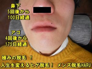 「青髭から卒業したい男たち」のリアルな叫び。ネット掲示板で語られるメンズ脱毛の真実と失敗しない選択肢