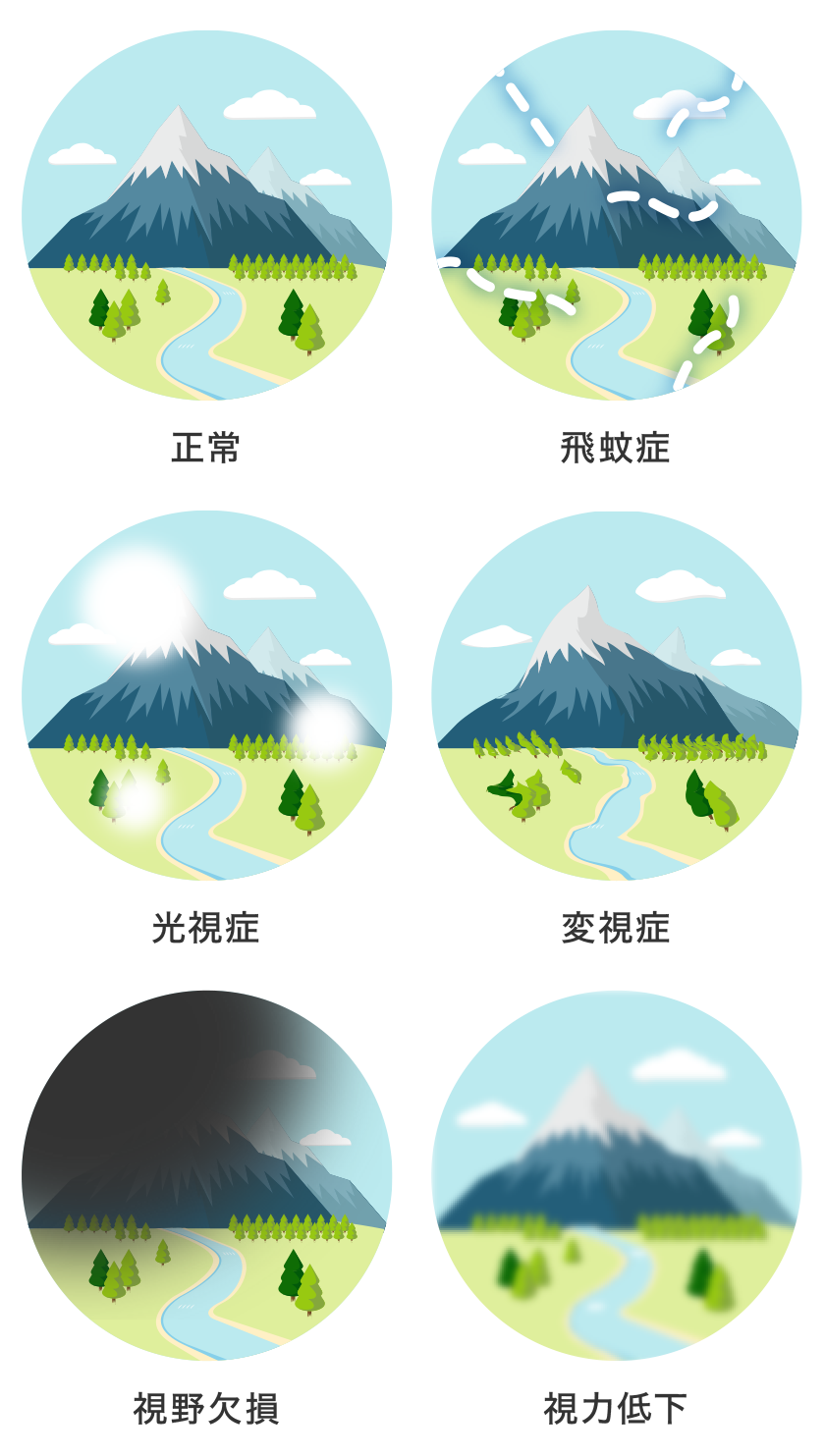 網膜剥離の見え方と前兆サイン｜黒い影や光が走る初期症状の緊急度と治療法