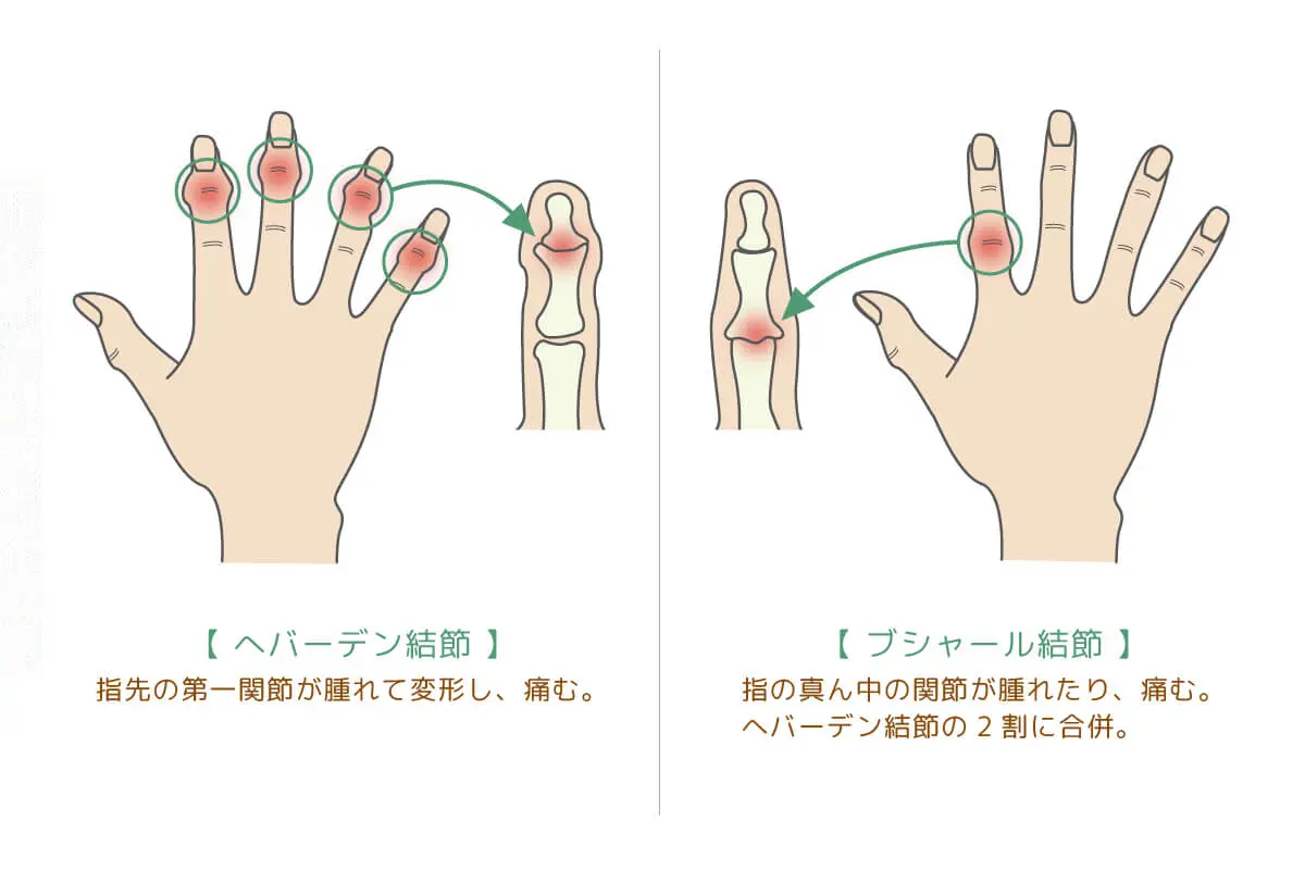 指の関節が太い原因と治す方法｜骨・指鳴らしの真相と指痩せケア