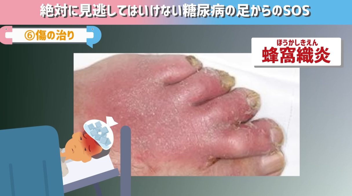 止まらぬ痒みは高血糖の警鐘か？症例画像で暴く糖尿病の皮膚病変